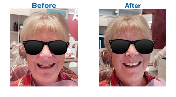 Before and after pictures at Honey Family Dental in Libertyville, IL